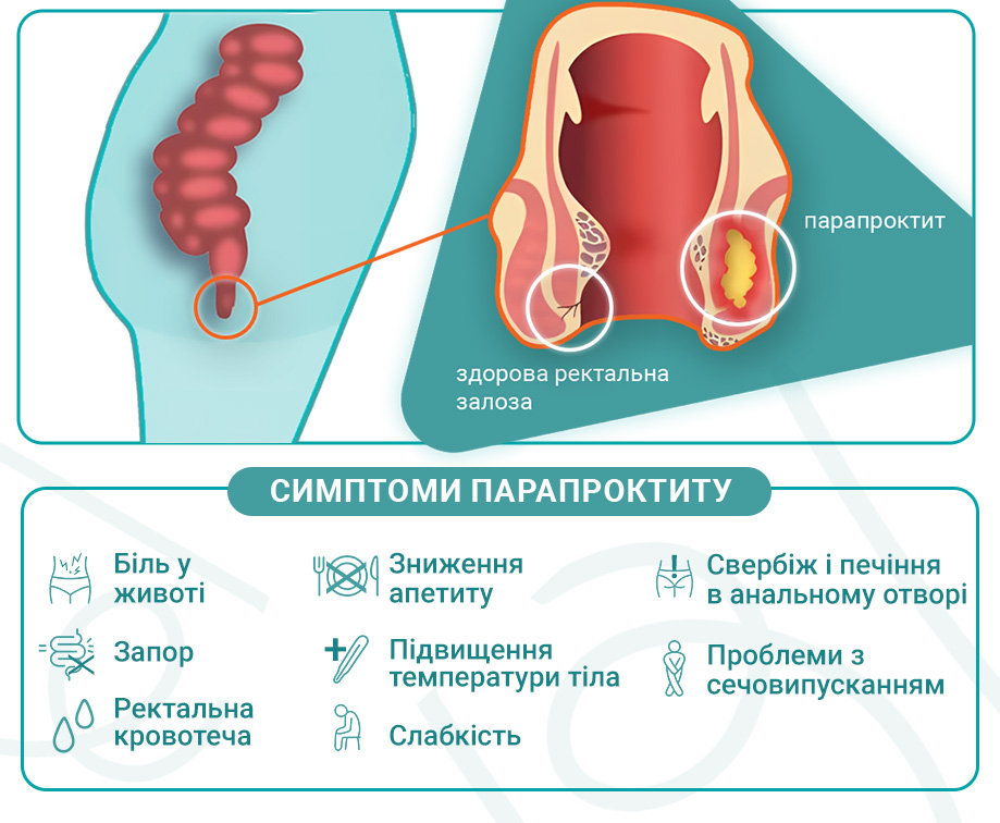 Симптоми парапроктиту.jpg Симптоми парапроктиту