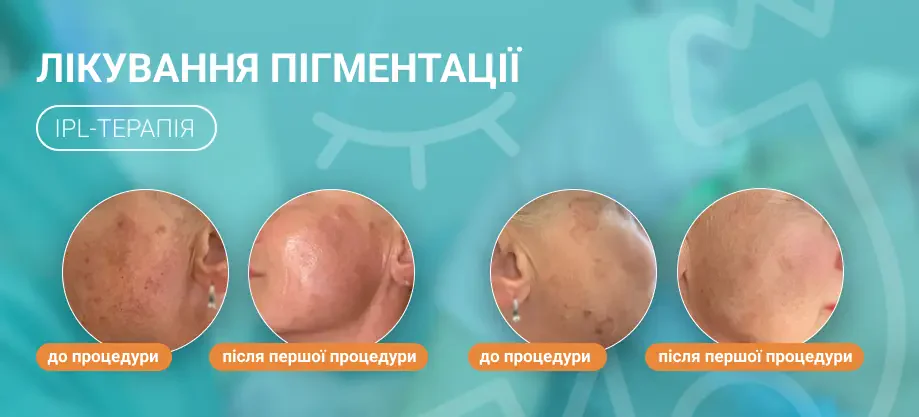 лечение пигментации
