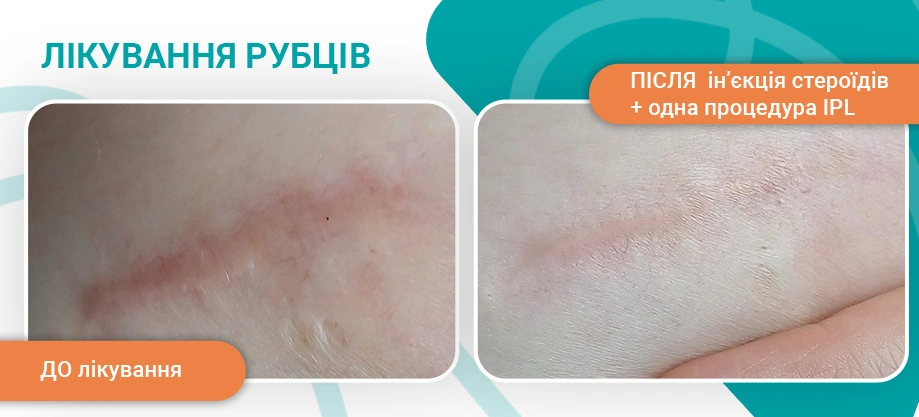 лечение шрамов в клинике на Печерске