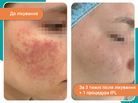 Кейс: лечение розацеа IPL-терапия