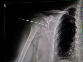 КТ ключицы 