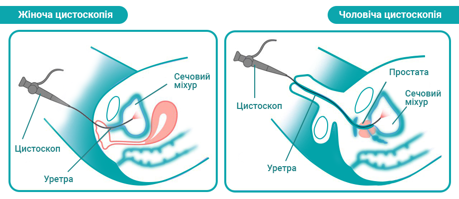 Цистоскопія_інфографіка_для_сайту_.png Цистоскопія