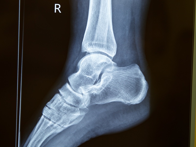 КТ гомілкостопу