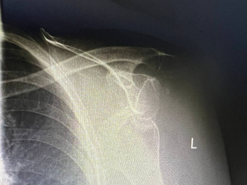 остеосинтез плеча ДО остеосинтез плеча до