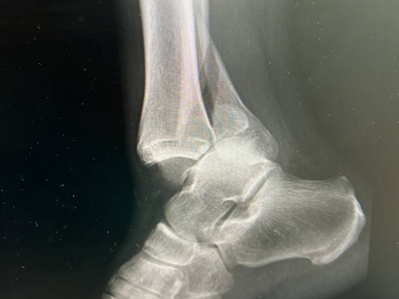 snimok_ostesintez goleni do.jpg знімок рентген стопа