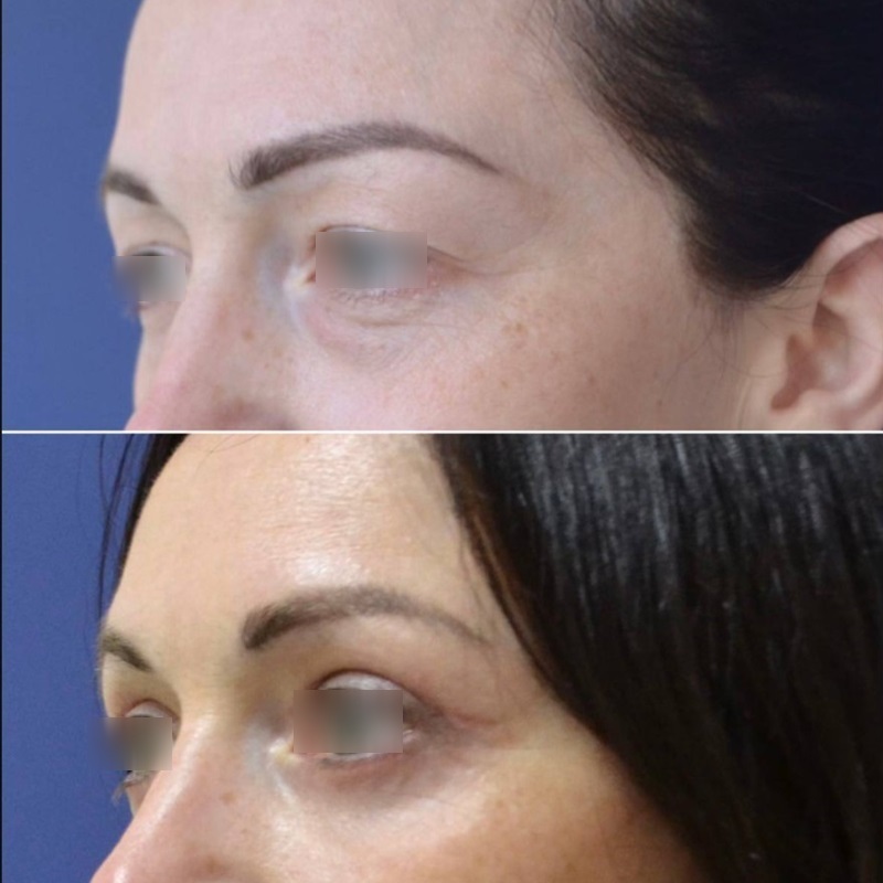 блефаропластика