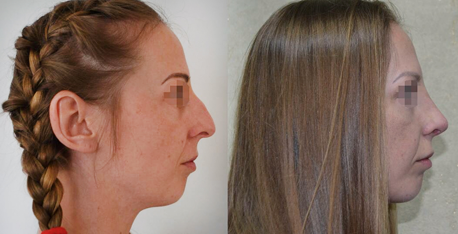 ринопластика