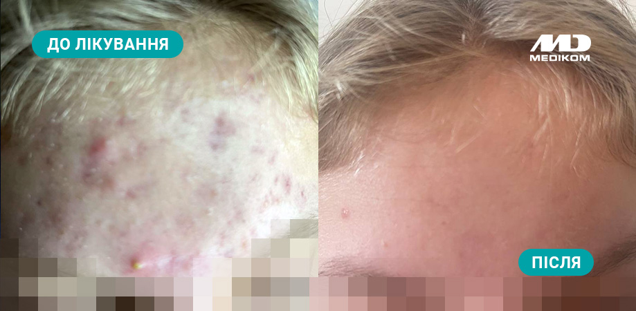 лікування проблемної шкіри у підлітків