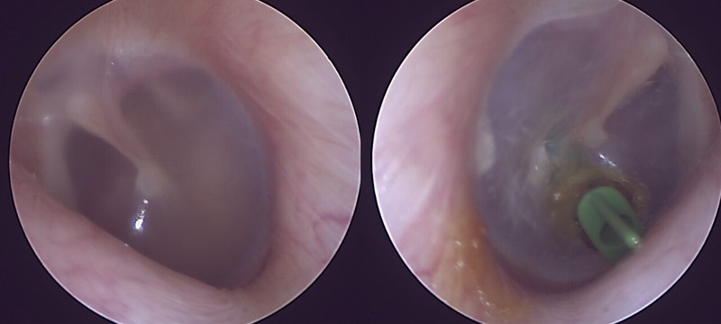 Шунтування перетинки вуха в Києві Шунтування перетинки