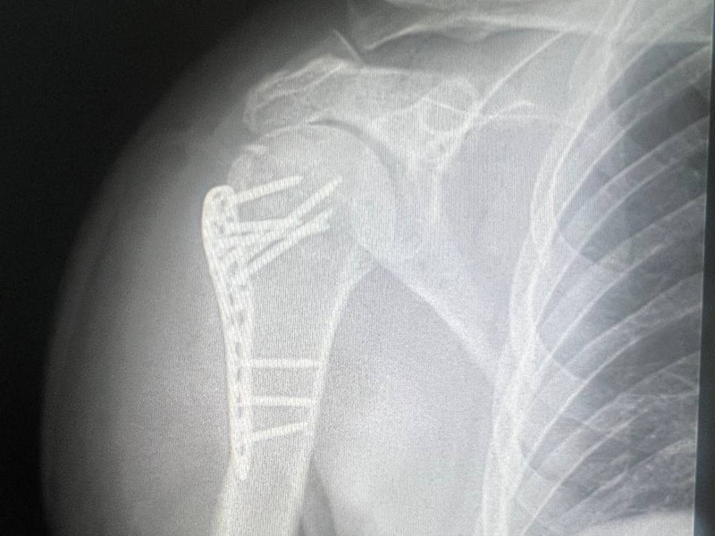Металоостеосинтез плечевої кістки ПІСЛЯ Металоостеосинтез плечевої кістки ПІСЛЯ