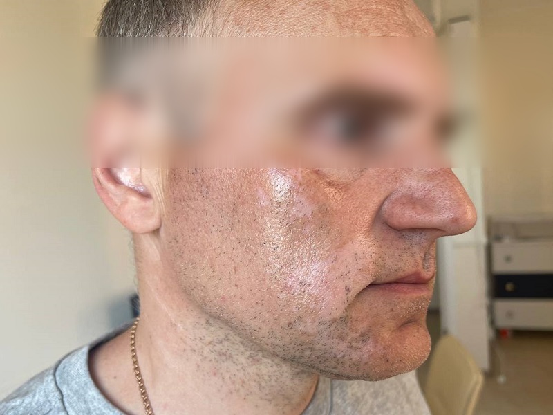 phpBScqWG_64da1451387bc0_34002950.jpg вітилиго до