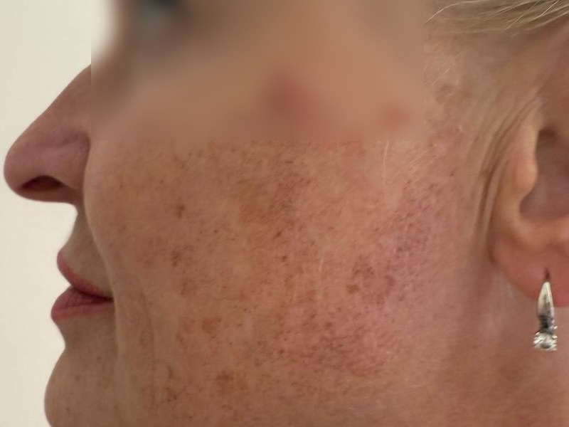 пігментація лікування пігментація лікування