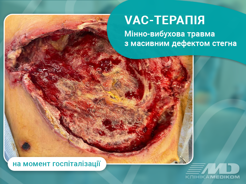 ВАК терапія