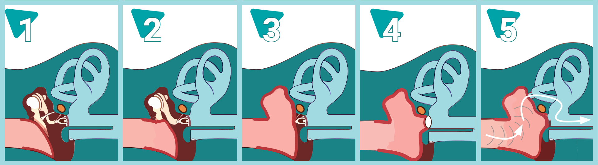 Методи тімпанопластики тимпанопластика виды