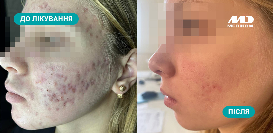 лікування вугрів у підлітків до-після