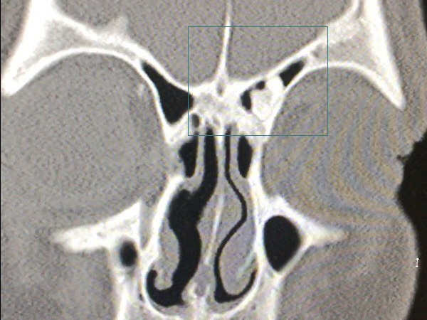 остеома лобової пазухи