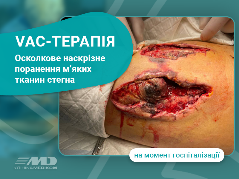 наскрізне поранення
