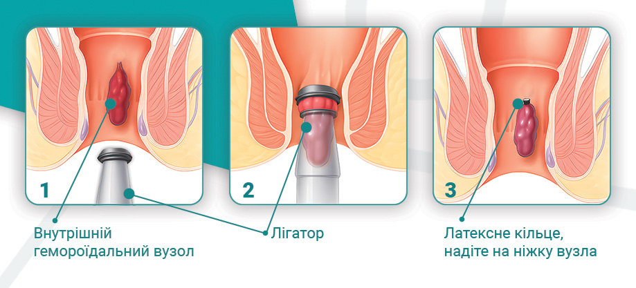 Інфографіка геморой латекс.jpg лігування геморою