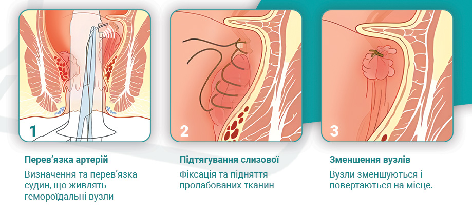 Інфографіка геморой HAL-RAR.jpg HAL-RAR