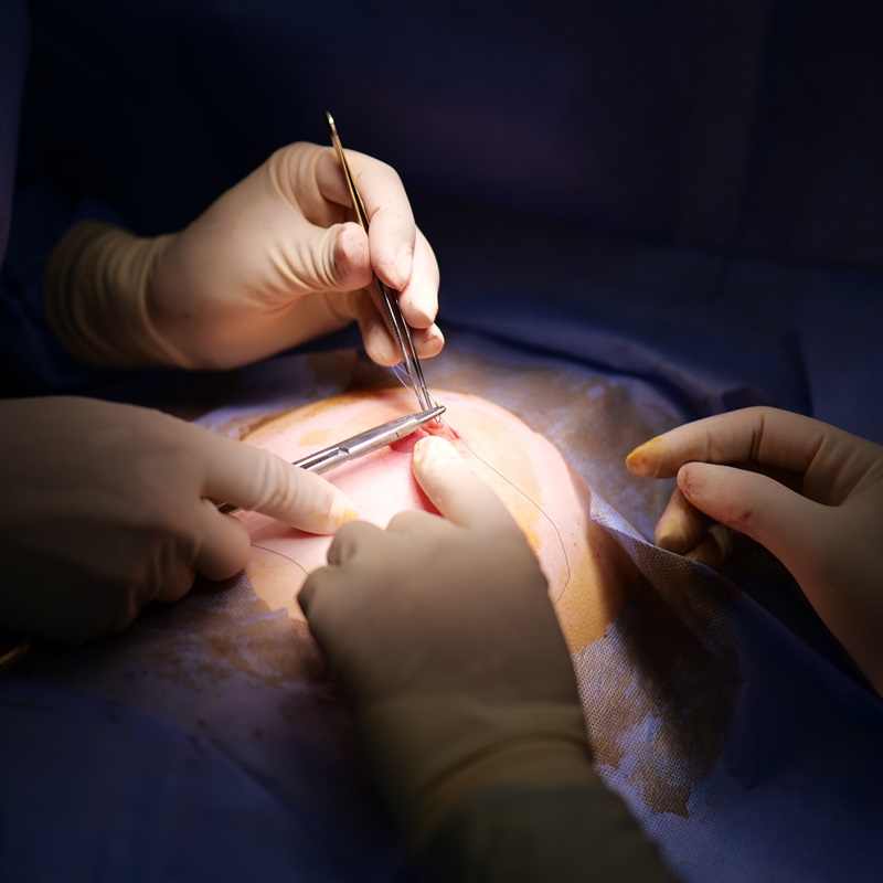 Кейс: секторальна резекцію молочної залози секторальна резекцію молочної залози