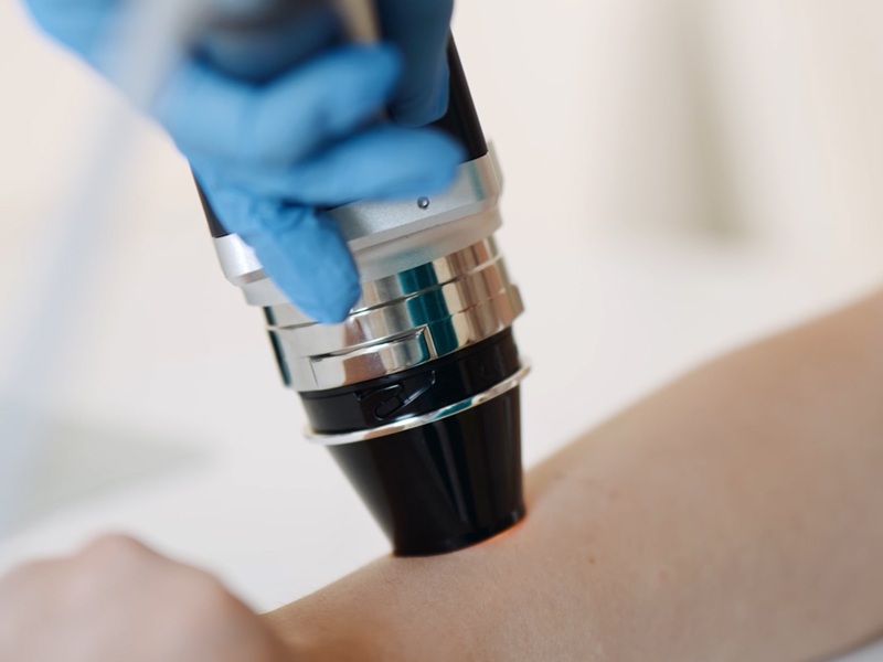 дерматолог невус