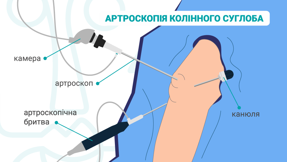 Артроскопія коліна в Києві артроскопія коліна
