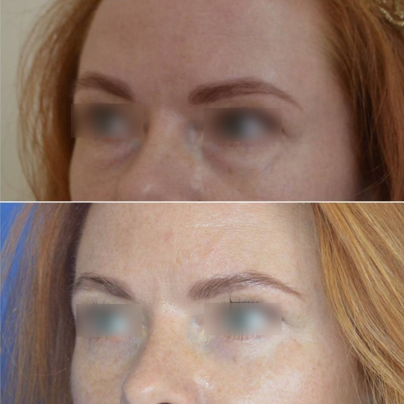 блефаропластика