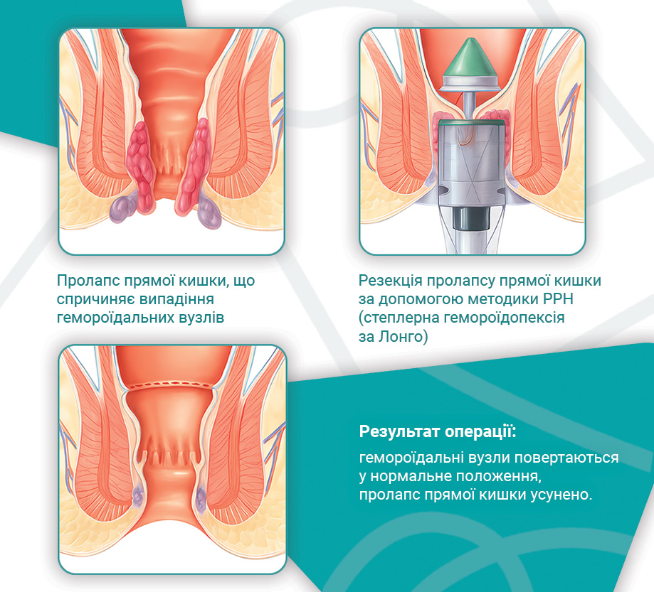 Інфографіка геморой Лонго.jpg PPH метод Лонго