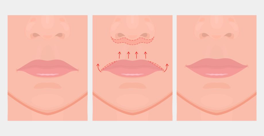 Показання до проведення хейлопластики
