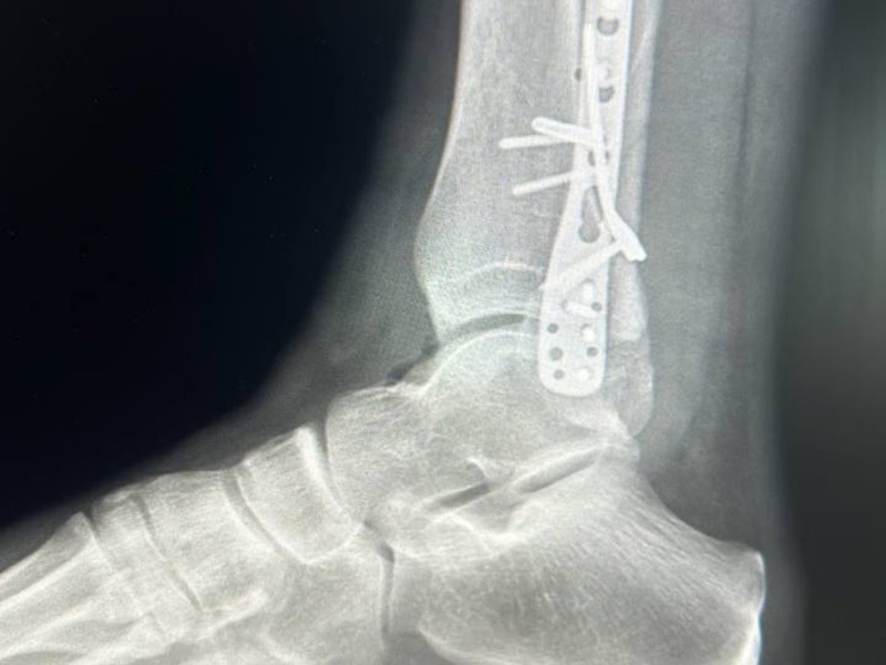 Металоостеосинтез гомілки ПІСЛЯ Металоостеосинтез гомілки ПІСЛЯ