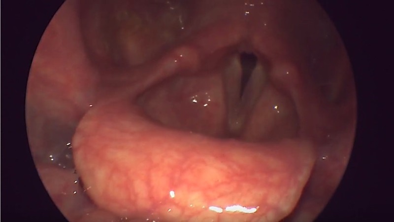Опорно-підвісна ларингоскопія: кейс ларингоскопия