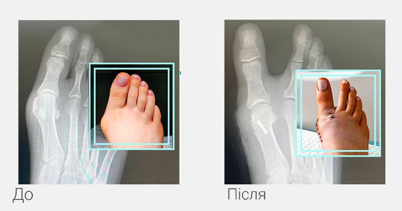 халюс вальгус операція до після