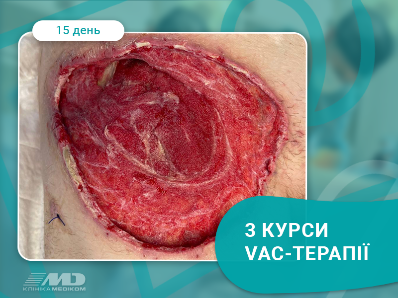 ВАК терапія