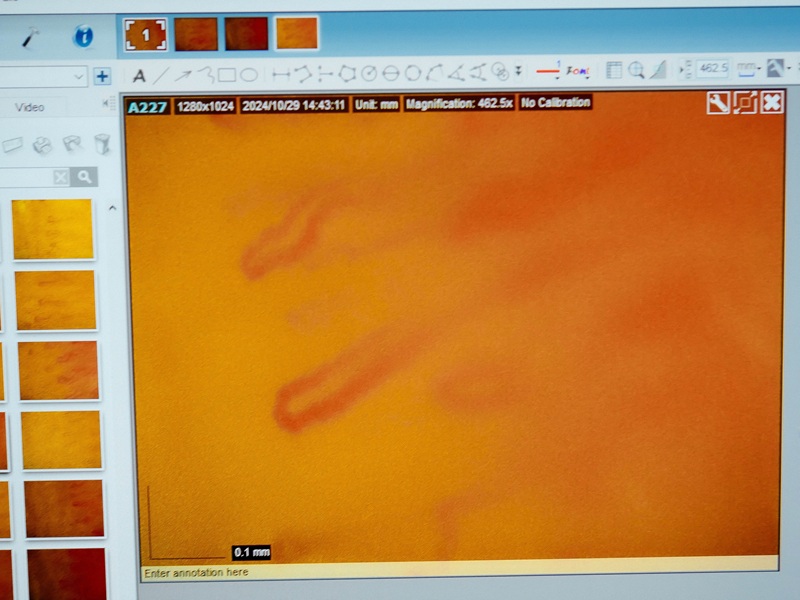 Склепротерапія склероскопія