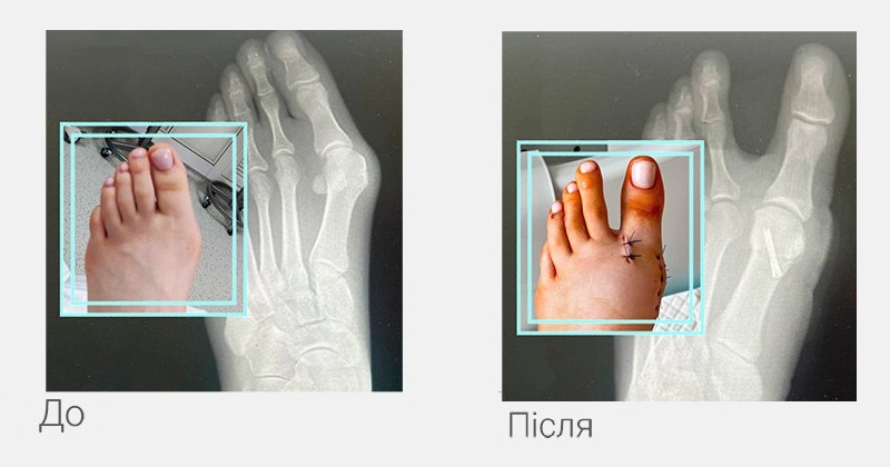 халюс вальгус операція до після