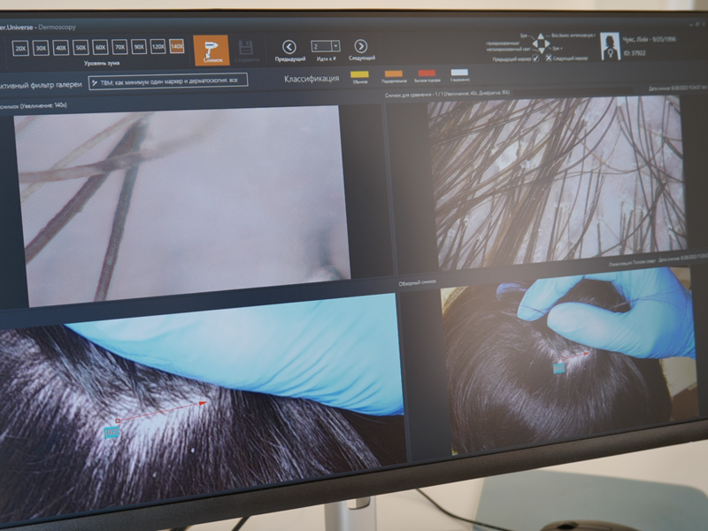 трихоскопія