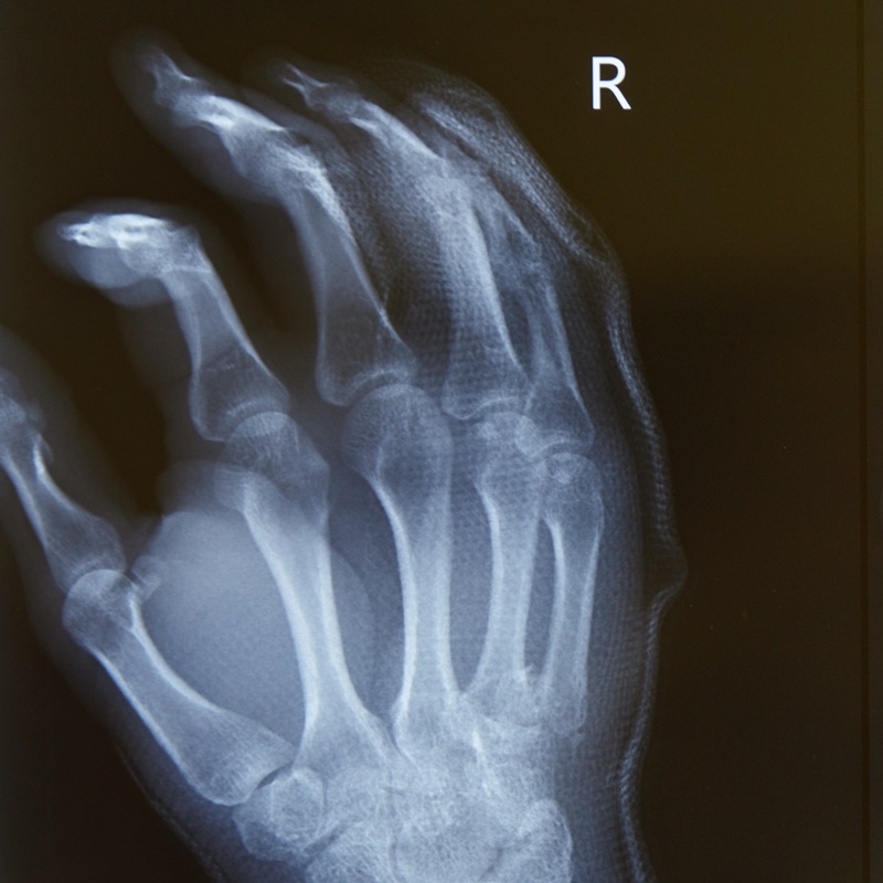 Знімок кисті рентген
