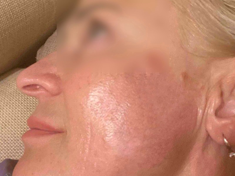 лікування пігментації після IPL лікування пігментації після IPL