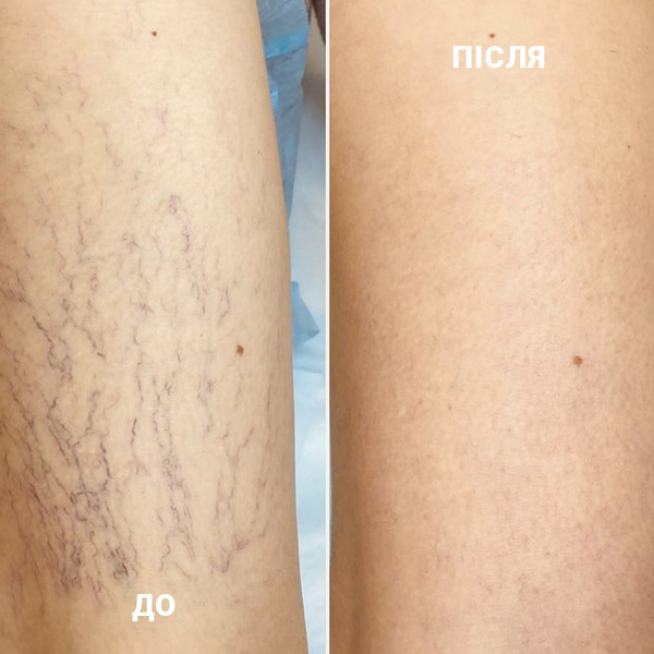 склеротерапия до после