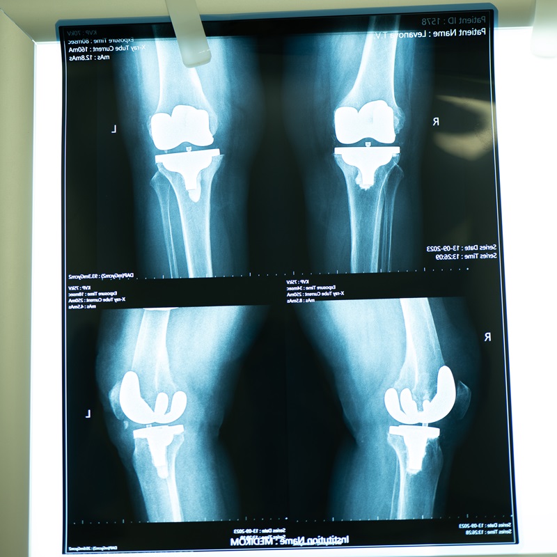 ендопротезування коліна