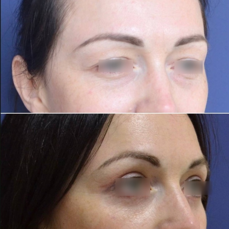 блефаропластика