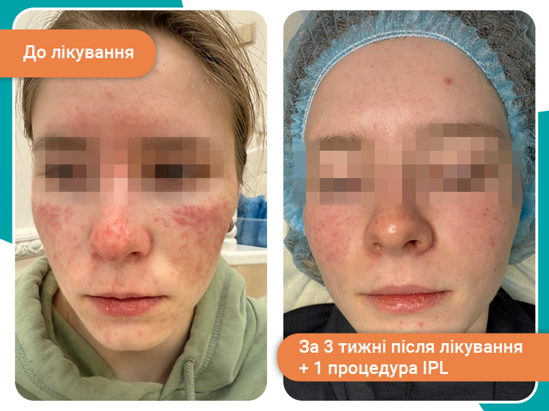 лікування розацеа лікування розацеа