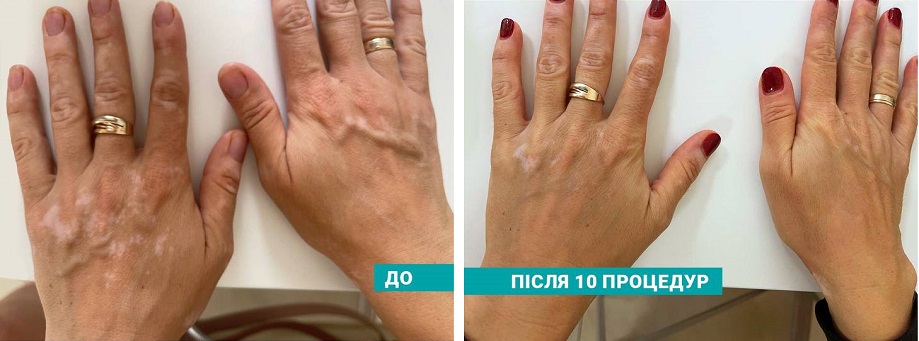 вітиліго до та після
