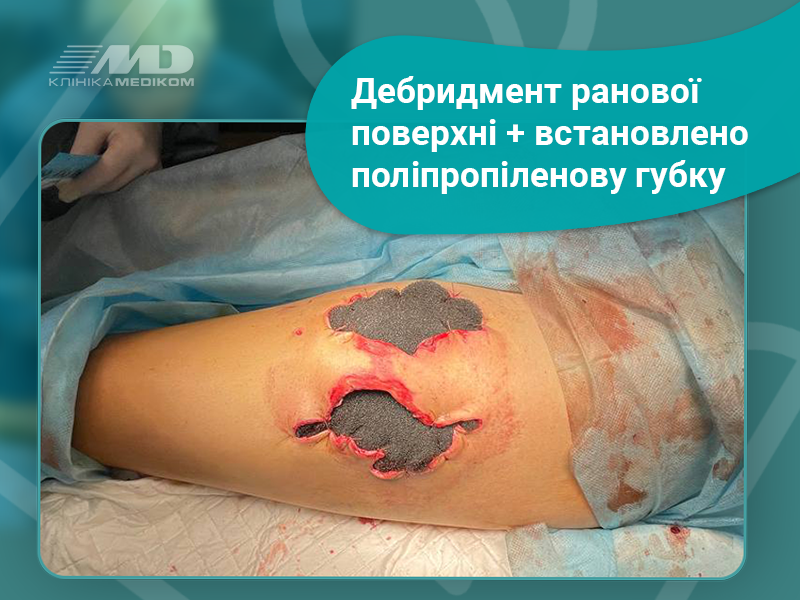 хірургія ран