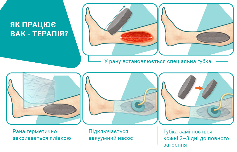 Як працює ВАК система.jpg ВАК терапія