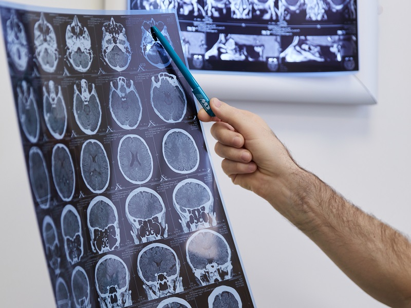 результат МРТ