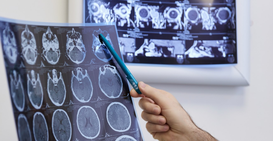 Показання до проведення фронтотомії