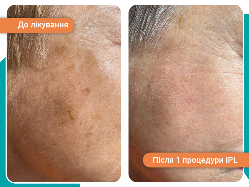 Після пігментація лікування Після пігментація лікування