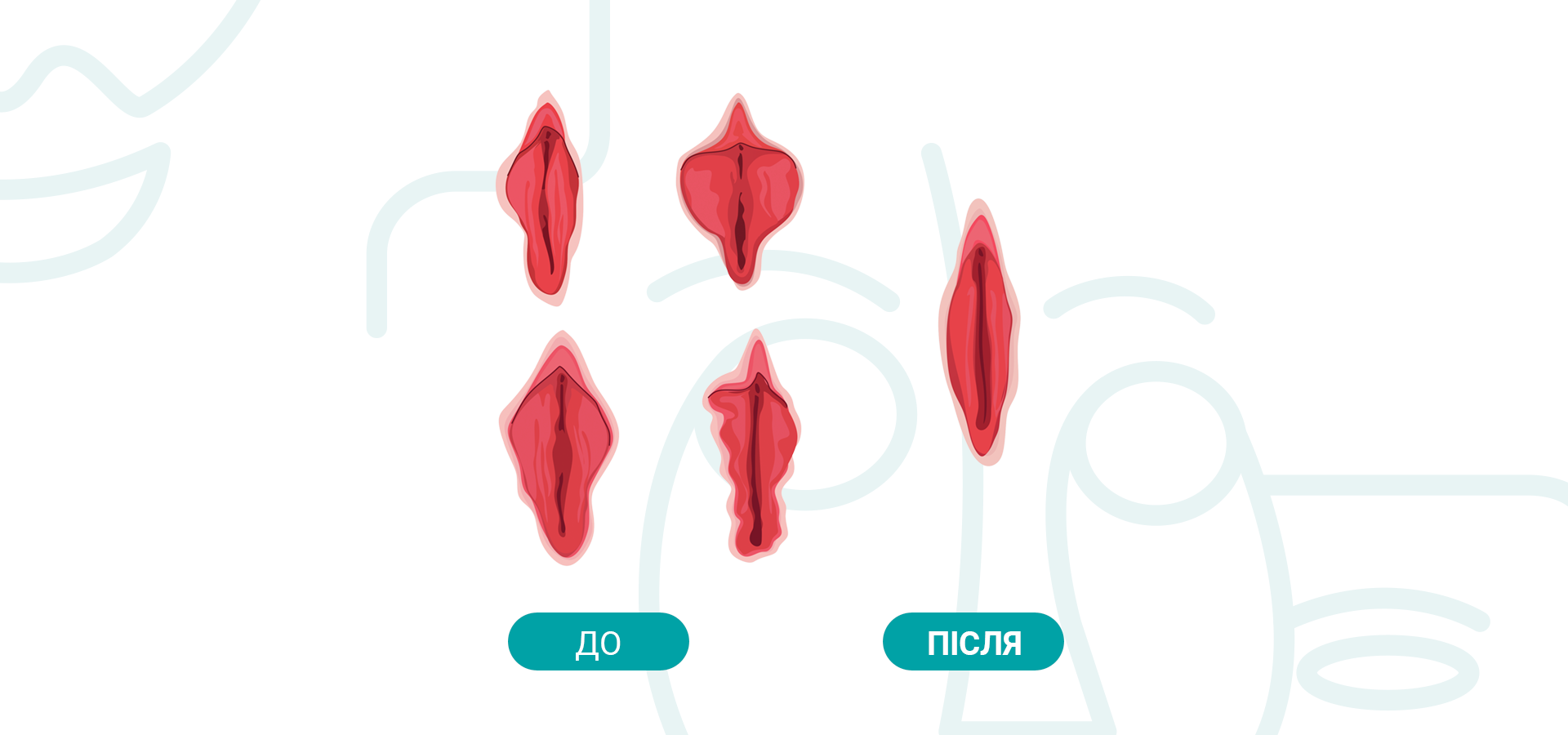 лабіопластика до після