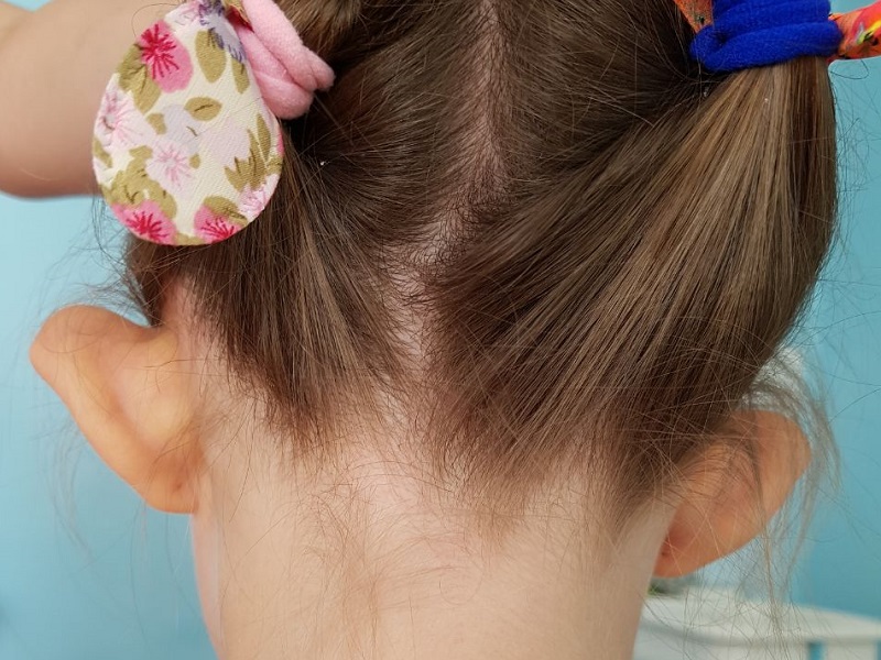 фото до отопластика